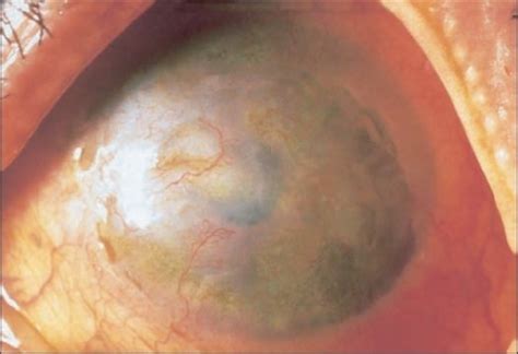 Hsv keratitis can be divided into 3 types: f3-co-1-441:Ganciclovir ophthalmic gel, 0.15%: a valuable ...
