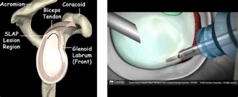 Arthroscopic Repair Of Capsule Labrum Knee Hip And Shoulder