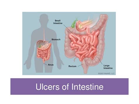 Ulcers Of The Intestine