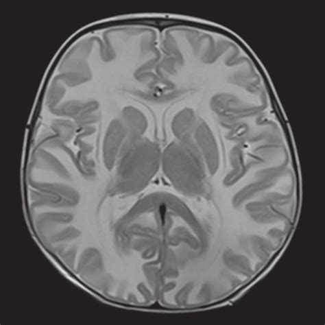 A Axial T2 Weighted Mri Shows Bilateral Diffuse Symmetric