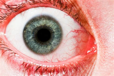 We also explore how people can protect their eyes. Pink Eye Said to be a Possible Symptom of COVID-19