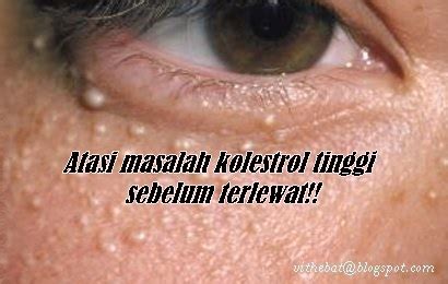 Petua hilangkan sakit gigi mujarab tanpa perlu makan ubat. Badan Sihat Hati Ceria: Cara hilangkan tanda putih ...