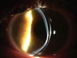 Maybe you would like to learn more about one of these? Scleral Lenses - First Eye Care Downtown Dallas
