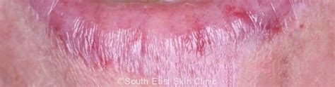 Iec Intraepidermal Carcinoma South East Skin Clinic