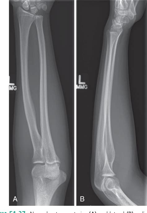 Normal Forearm X Ray