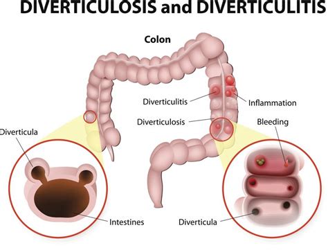 What Is Diverticulitis Symptoms Causes And Treatments Healthy Magazine