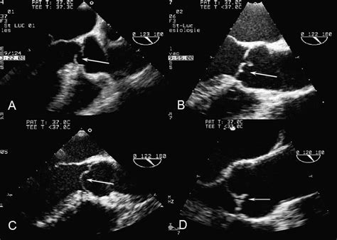 Functional Anatomy Of Aortic Regurgitation Circulation