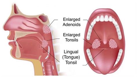 Adenoiditis Definition Causes Symptoms Diagnosis Treatment Prognosis