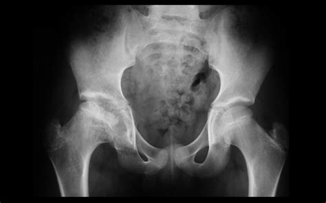 Avascular necrosis (AVN), right femoral head epiphysis ...