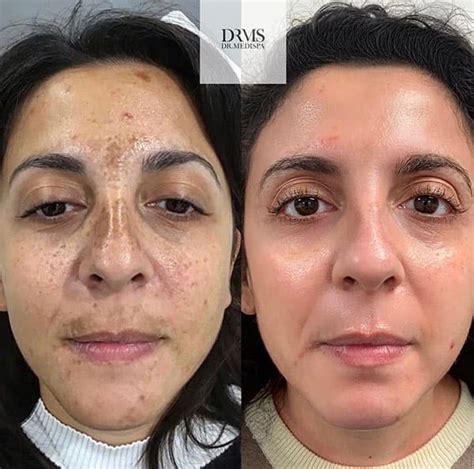Cosmelan® Depigmentation Treatment In Dallas Hyperpigmented