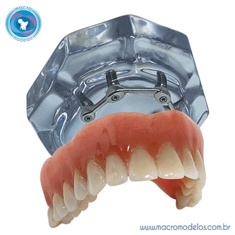 Overdenture Superior Barra Clip