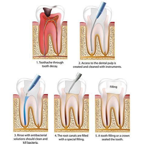 Root Canal Endodontics Dentist In North Syracuse NY Gregory