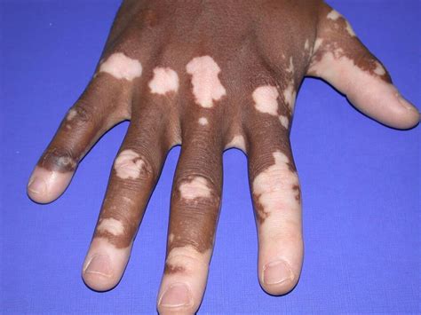 There are many different types of skin diseases and many different causes of. Vitiligo - Huidarts.com