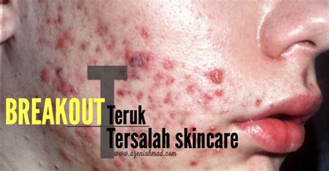 We did not find results for: Kulit Muka Breakout Akibat Tersalah Skincare - azeniahmad.com