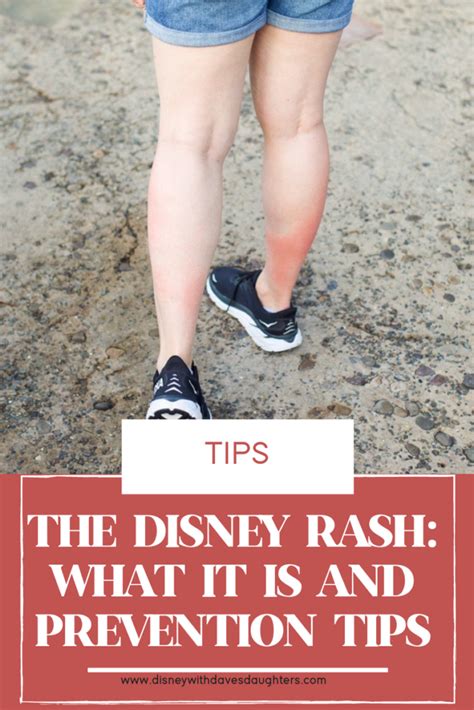 Disney Rash Symptoms Treatment And Prevention