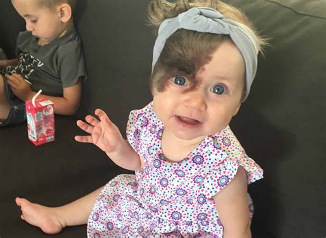 Help This Little Girl Born With Facial Birthmark Raise Funds For