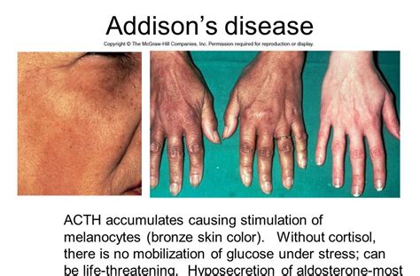 Hyperpigmentation Of The Skin In Addisons Disease