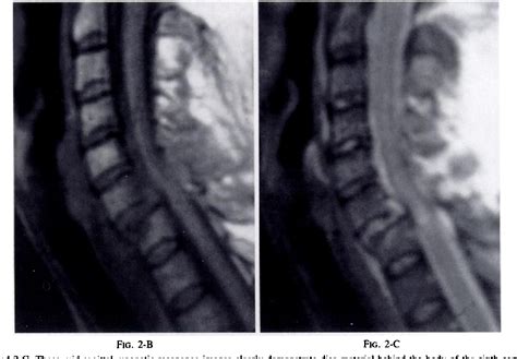 Figure 2 From Extrusion Of An Intervertebral Disc Associated With