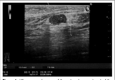 Figure 1 From Clinical Presentation Along With Imaging Features Of