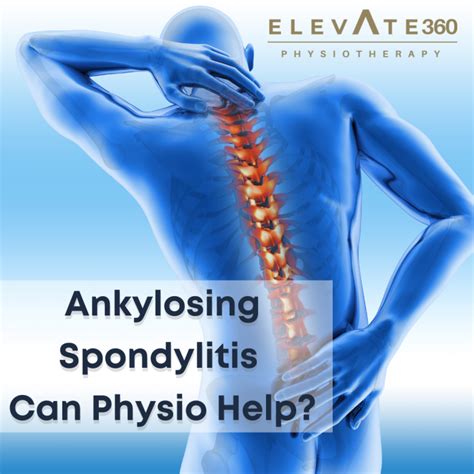 Ankylosing Spondylitis Can Physio Help Elevate Physiotherapy
