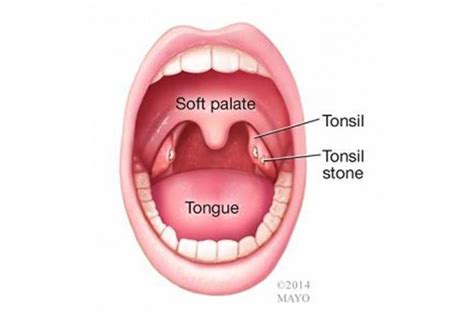 Apa itu pharynx dan tonsils? Kaedah membuang dan mencegah batu tonsil mulut hanya dari ...