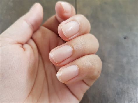 Peeling Nails What It Could Mean Best Health Canada