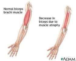 Diseases - The Muscular System