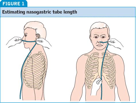 Figure 1 From Nasogastric Tube Insertion In Adults Who Require Enteral