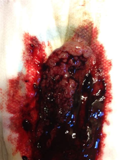 Period blood clots are not always a reason for concern. Period after failed FET (TMI blood clot, Tissue) - Glow Community