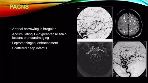 Reversible Cerebral Vasoconstriction Syndrome Ppt