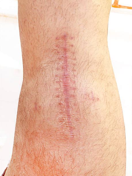 Download knee replacement images and photos. Best Knee Surgery Scars Stock Photos, Pictures & Royalty ...
