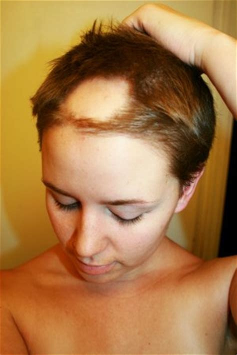 J am acad dermatol 1985; Alopecia Areata (s fotkami) | eOtazky.sk