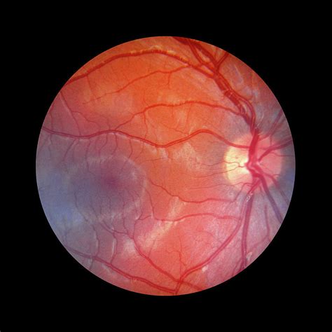 Fundus Camera Image Of A Normal Retina Photograph By Rory Mcclenaghan