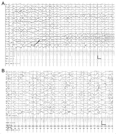 Electroencephalography Eeg Recorded At 5 Months Shows A Right