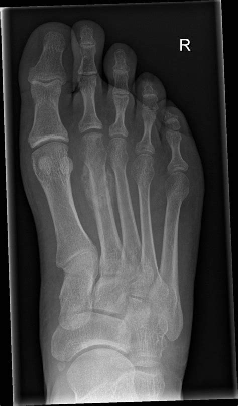 Stress fractures refer to fractures occurring in bone due ...