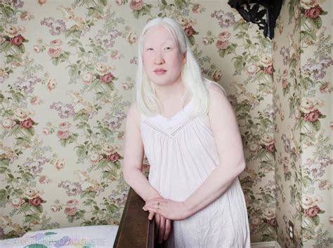 Albinism Photographs Popsugar Beauty Photo The Best Porn Website