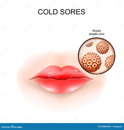 Cold Sores in the Lip. Fever Blisters Stock Vector - Illustration of