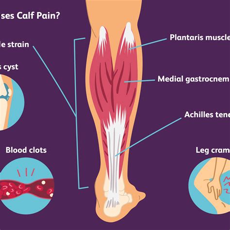 Leg Pain From Hip To Foot Sciatica Pictures Symptoms Causes And