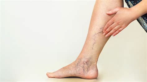 Varicose Veins Symptoms And Treatments Maryland Vascular Specialists