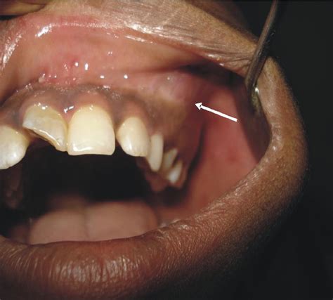 Intraoral View Showing Swelling Extending From 22 Distally Upto 25