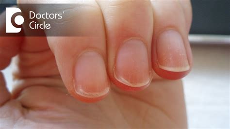 What Causes Your Nails To Peel Nail Ftempo