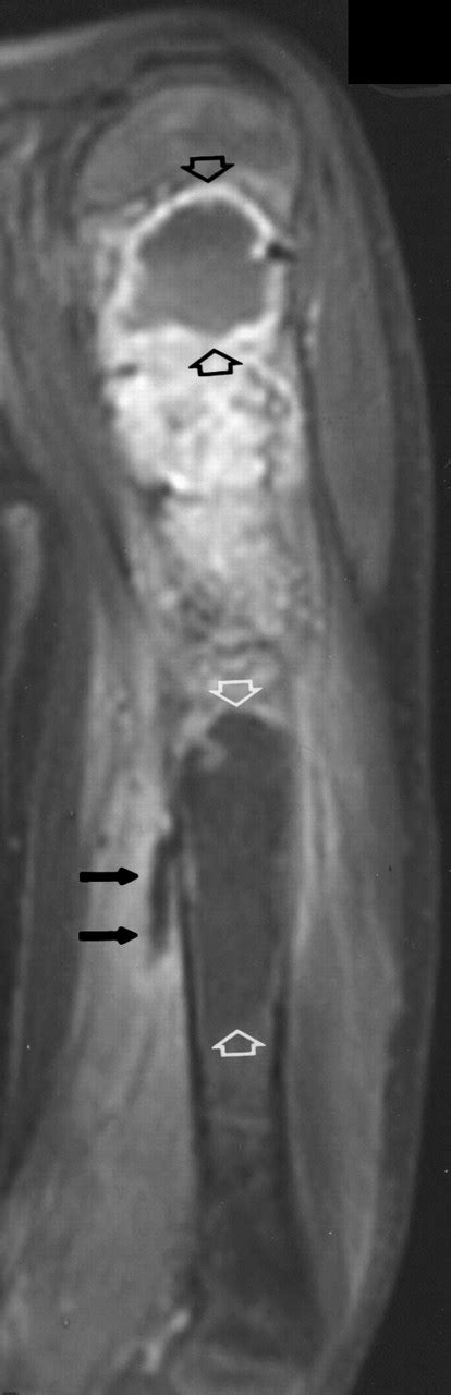 Imaging Findings Of Fibrous Dysplasia With Histopathologic And