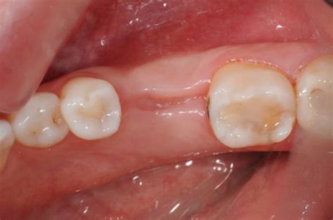 Healing Time For Tooth Extraction What To Know Asian Sun Dental