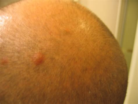 Red Bumps On Scalp Dorothee Padraig South West Skin Health Care