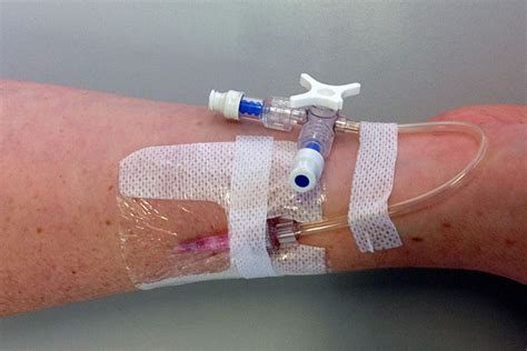 How To Assess A Peripheral Intravenous Iv Cannula Ausmed