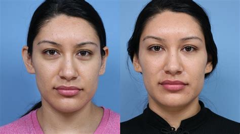 Dermal Fillers Before And After Do S And Don Ts For Wrinkles Lips And More