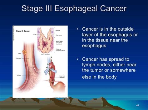 Esophageal Cancer Lymph Nodes