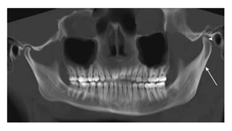 Imaging Of The Temporomandibular Joint An Update