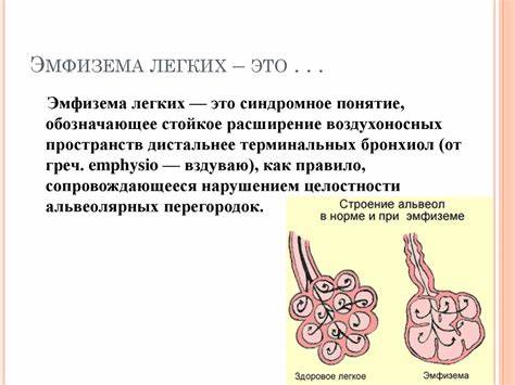 Эмфизема легких диета Патоморфология эмфиземы легких - презентация онлайн Патоморфология эмфиземы легких - презентация онлайн Эмфизема легких диета