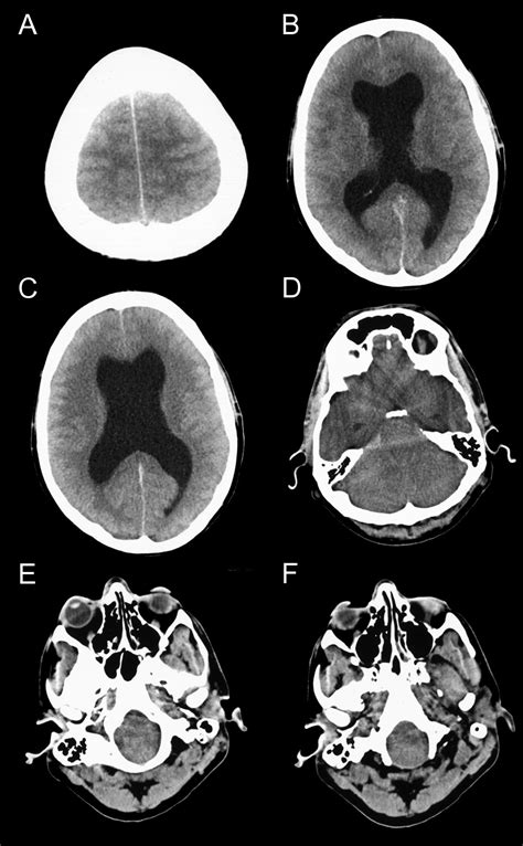 Marathon related death due to brainstem herniation in rehydration-related hyponatraemia: a case 